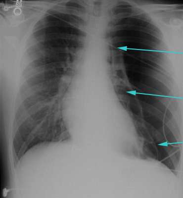 Assessment of pleuritis images