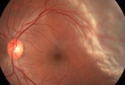 Descolamento de retina images