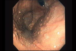 Familial adenomatous polyposis syndromes images