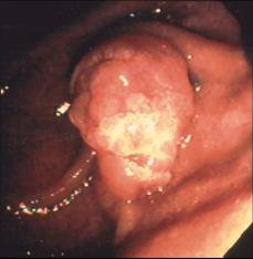 com.bmj.content.model.Caption@66171636