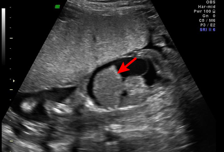 Incompatibilidad Rh images