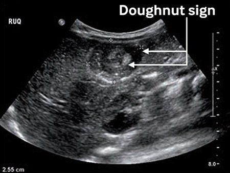 Intussusception images