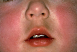 Erythema infectiosum images