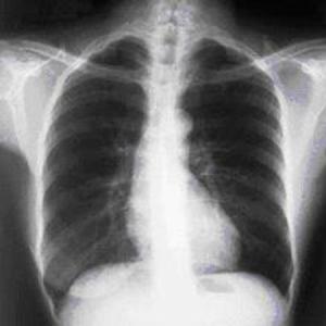 Assessment of chronic cough images