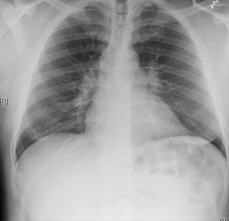 Evaluation of chronic cough images