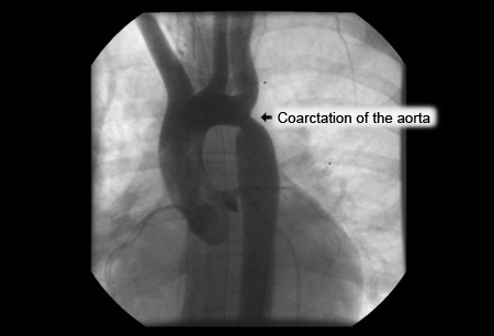 Aortic coarctation images
