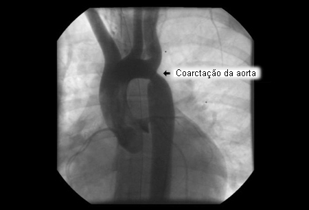 Coarctação aórtica images