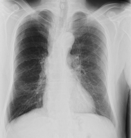 Chronic obstructive pulmonary disease (COPD) images