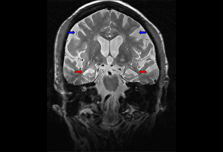 Evaluation of memory deficit images