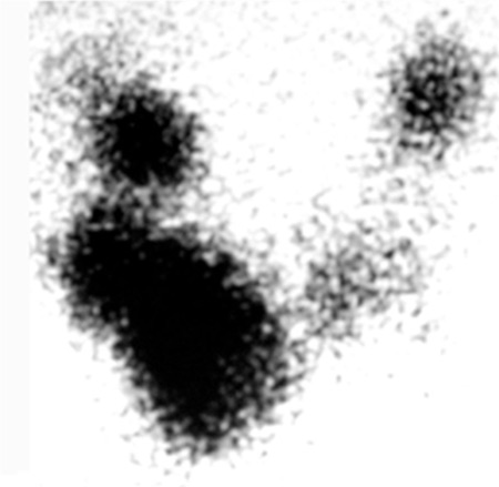 Toxic multinodular goitre images