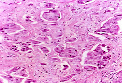 Primary invasive breast cancer images