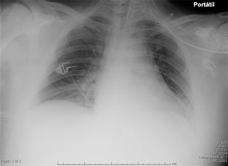 Pneumonia hospitalar (não COVID-19) images