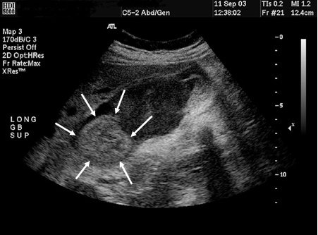 Cholangiocarcinoma images