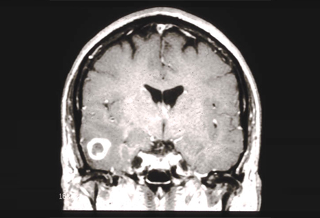 Gliomas images
