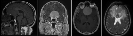 Meningioma images