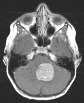 Medulloblastoma images