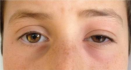 Peri-orbital and orbital cellulitis images