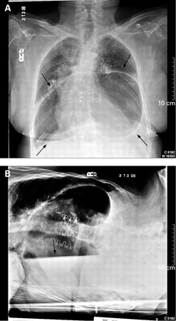 Hérnia de hiato images