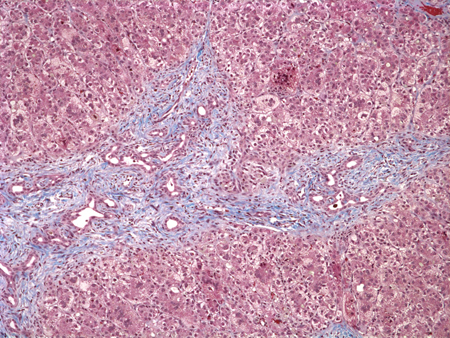 Biliary atresia images