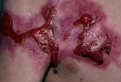Epidermólise bolhosa images