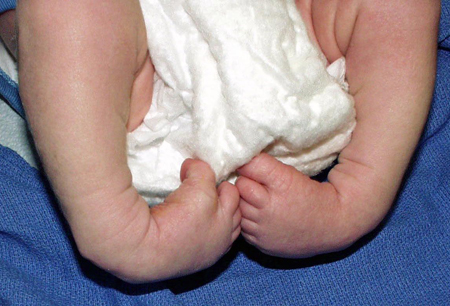 Equinovarus foot deformity images