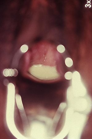 Vaginite images