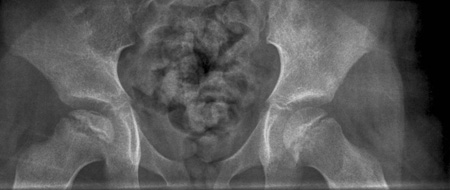 Legg-Calvé-Perthes' disease images