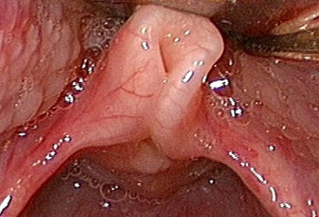 Laryngomalacia images