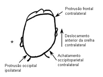 Torcicolo congênito images