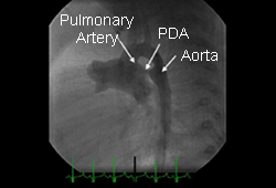 Patent ductus arteriosus images