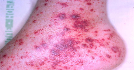 Assessment of lower extremity mononeuropathy images