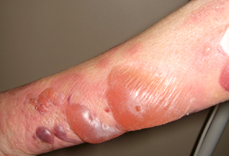 Assessment of vesicular-bullous rash images