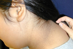 Type 2 diabetes in children images