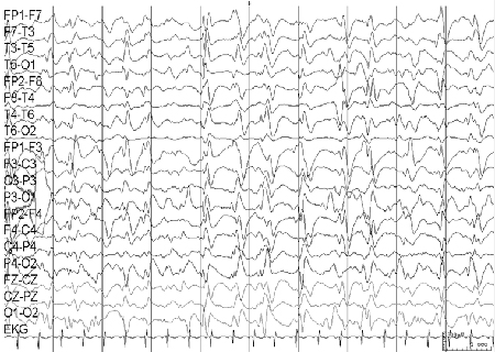Generalised seizures in children images