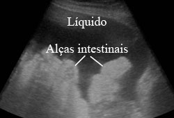 Peritonite bacteriana espontânea images