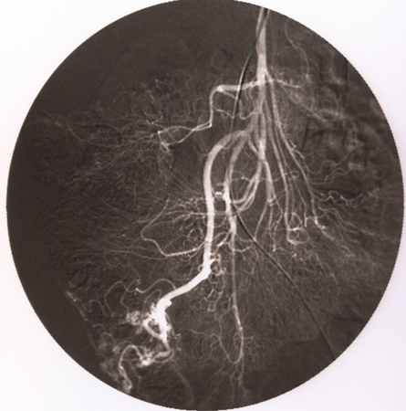 Angiodysplasia of the colon and small intestine images