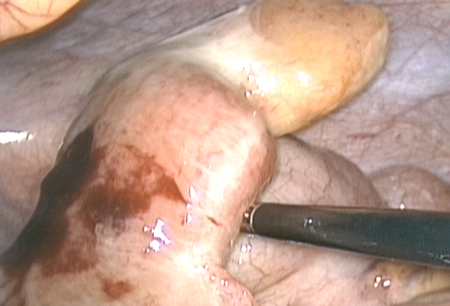 Meckel's diverticulum images