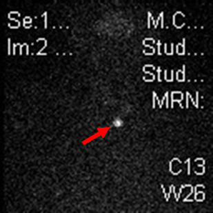 Tireoidite subaguda images