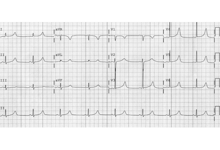 Long QT syndrome images