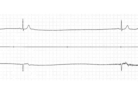 Bradycardia images