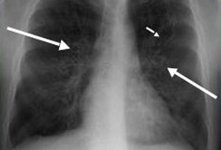 Allergic bronchopulmonary aspergillosis images