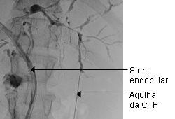 Colangite esclerosante primária images
