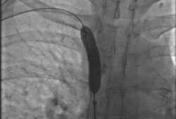 Superior vena cava syndrome images