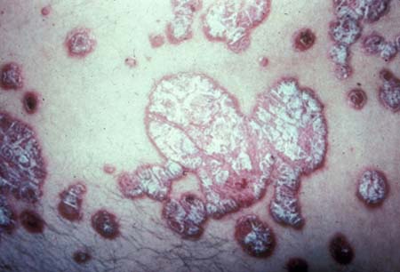 Evaluation of dermatologic disorders in HIV images