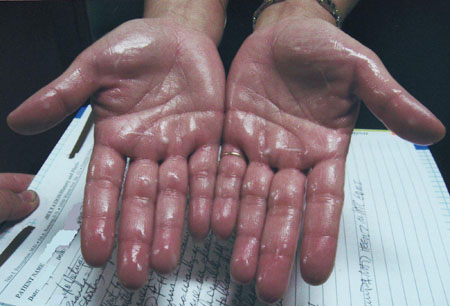 Hyperhidrosis images