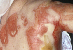 Assessment of rash in children images