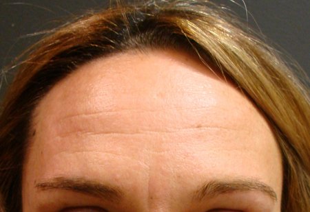 Wrinkles images