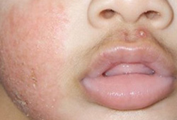 Eczema images