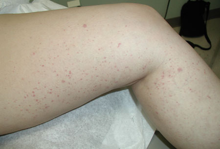 Crioglobulinemia images