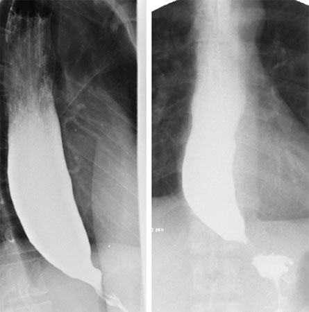 Achalasia images